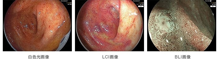 画像強調観察BLI/LCI機能に対応