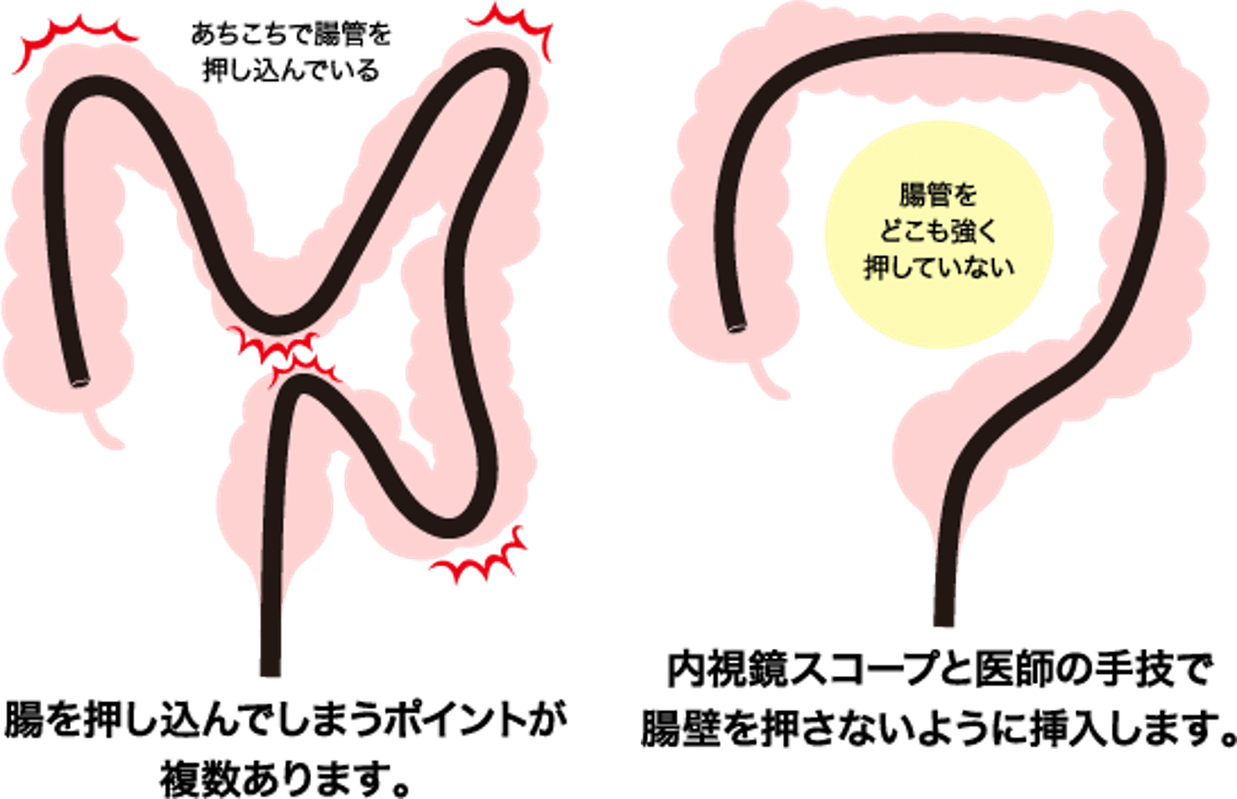 内 鏡 食事 検査 視 大腸