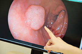 大腸がん予防のための日帰り大腸ポリープ切除