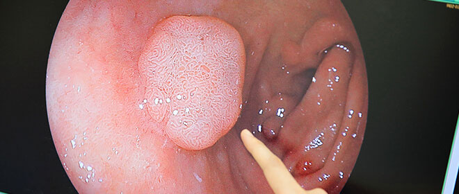 大腸がん予防のための日帰り大腸ポリープ切除